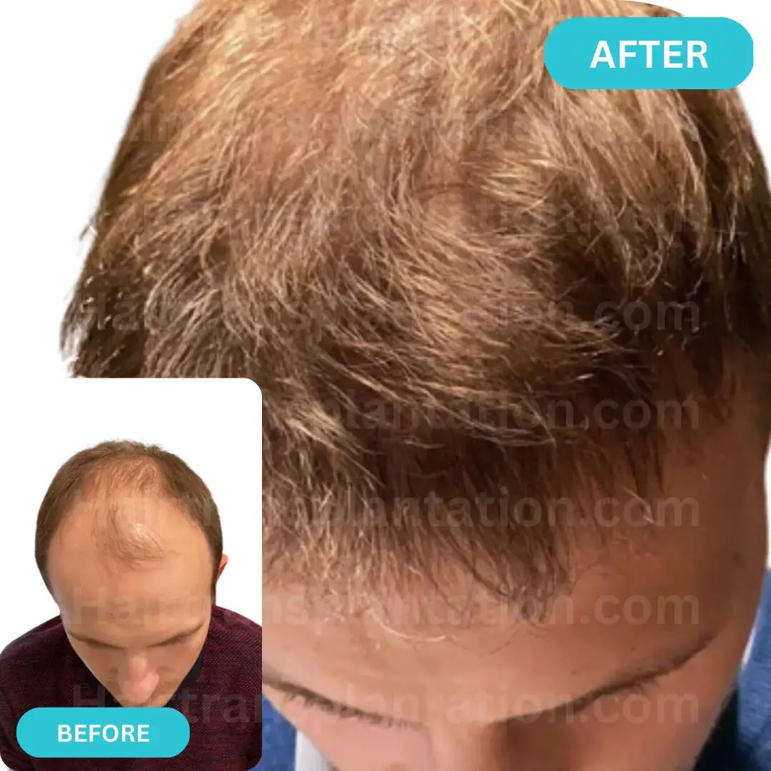 Hairtransplantation.com-Before-After-Picture-11.webp