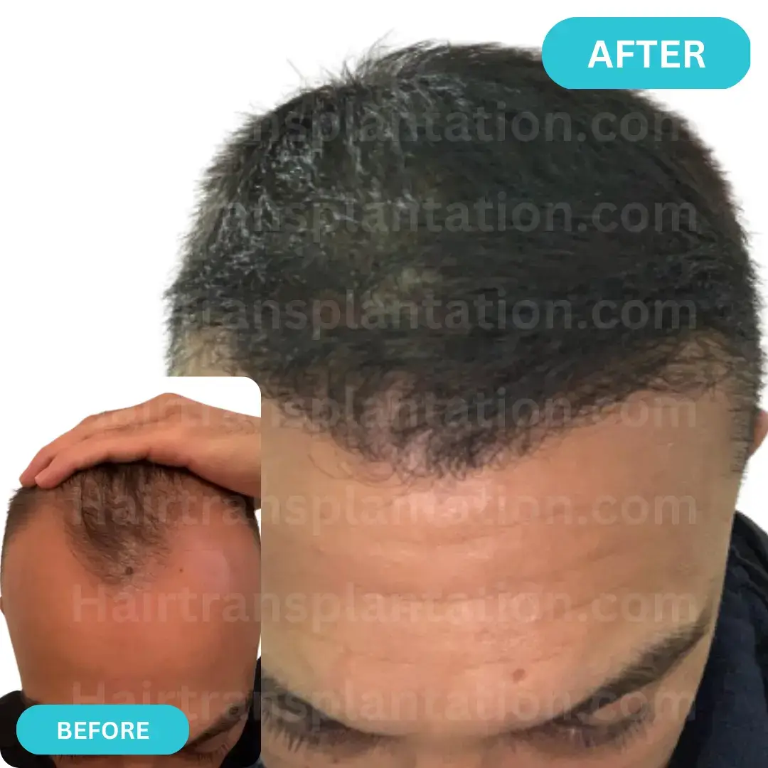 Hairtransplantation.com-Before-After-Picture-12.webp