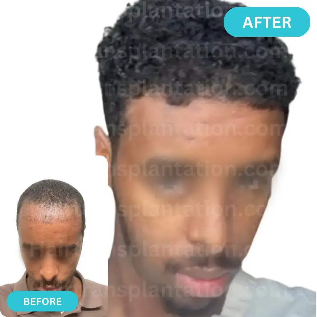Hairtransplantation.com-Before-After-Picture-2.webp