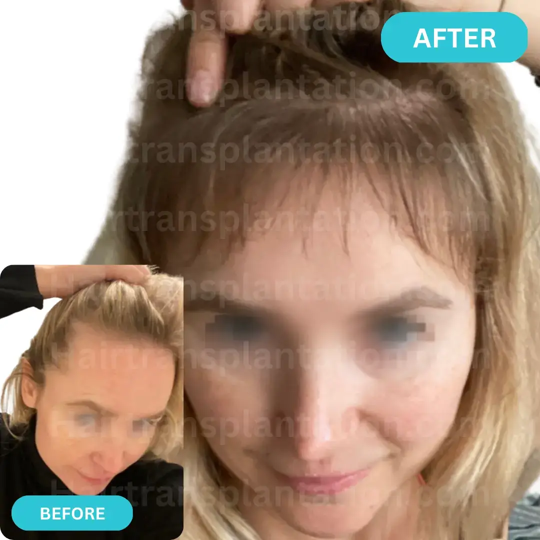 Hairtransplantation.com-Before-After-Picture-3.webp