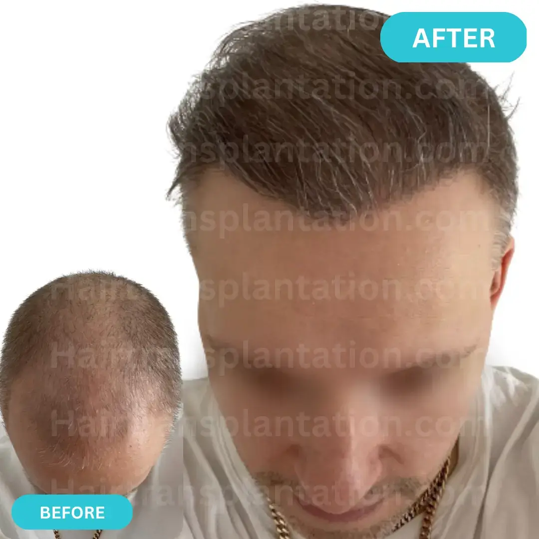 Hairtransplantation.com-Before-After-Picture-4.webp