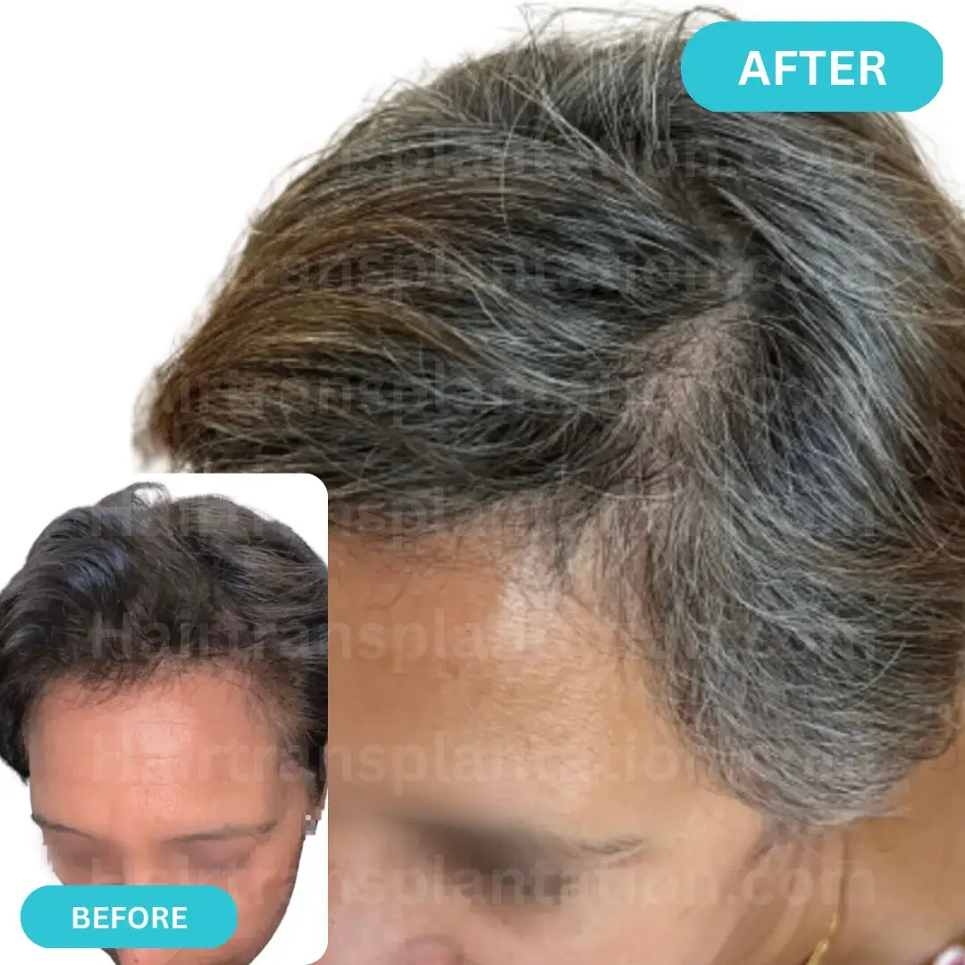 Hairtransplantation.com-Before-After-Picture-6.webp